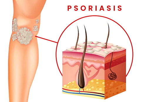 BIORAMAX PsoriaRescue Treatment Spray