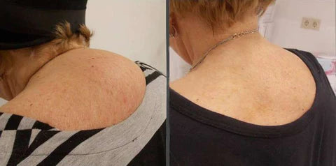 Liacsy™ FreezeSilk Lymphvitya grudnjak za podizanje