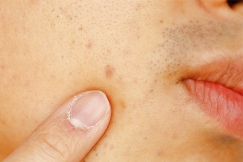 Prevent acne scars