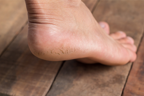 Anammyaa Wellness A Way To Good Health - Do you have Cracked Heels. Cracked  heels condition is called ”Padadari' in Ayurveda. Paada means feet / heels.  Dari, Darana means cracking. It is