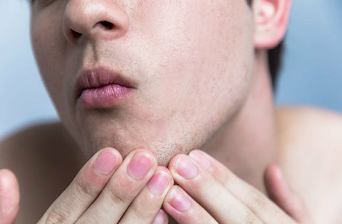 Men is seeing his bumps and dry patches on his chin
