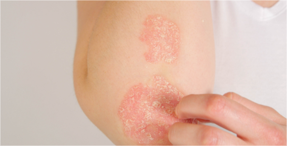 Atopic Eczema image