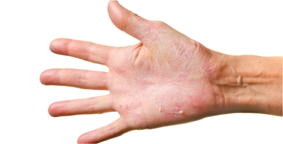 Hand Dermatitis image