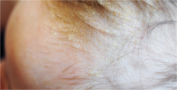 Seborrheic Dermatitis image