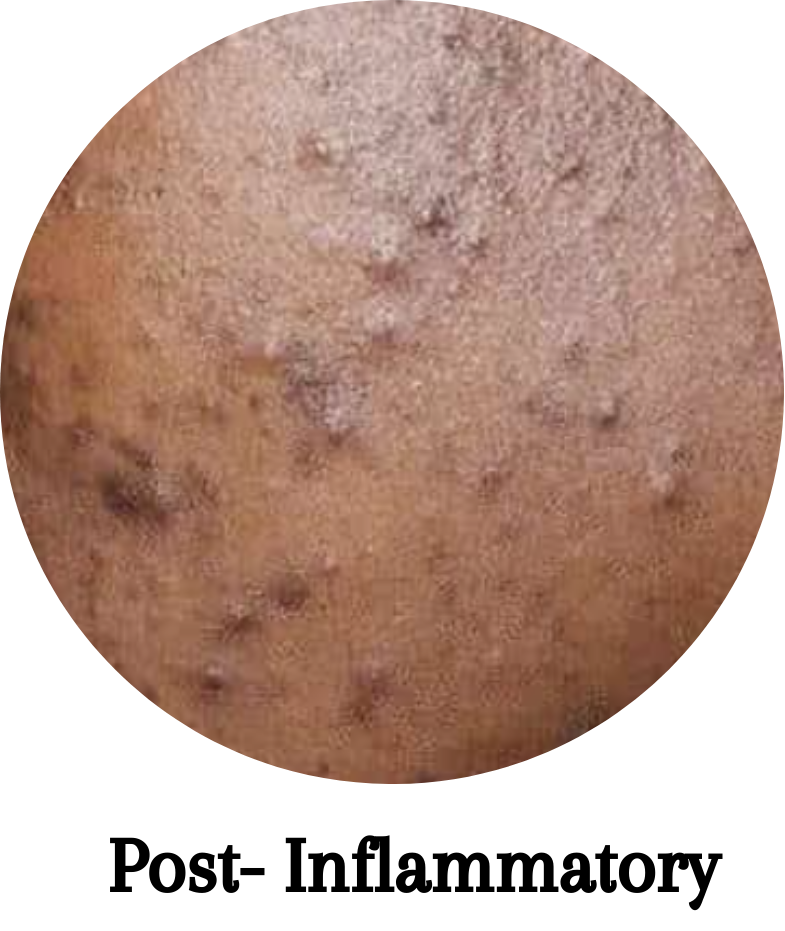 Post-Inflammatory Hyperpigmentation