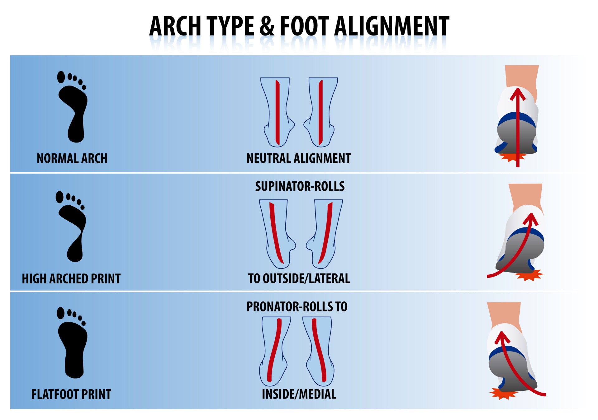 Diagram of foot types and how they affect pronation