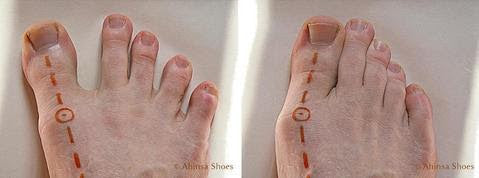 A bare foot with a healthy toe position vs. a foot suppressed into an unnaturally small space.  