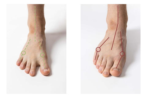 Centered foot with the ankle in an ideal position vs. everted ankles