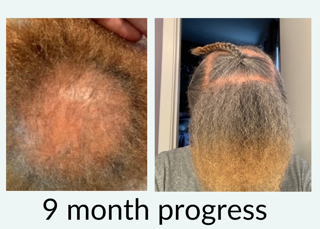 hair growth before and after