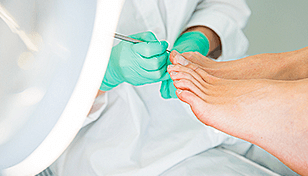 Ingrown Toenails