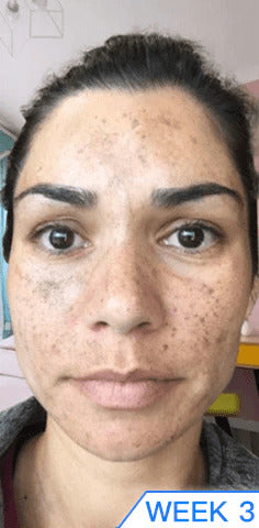 ENVISHA™ Dark Spot And Acne Corrector Cream