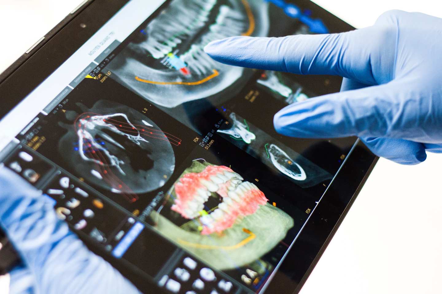 Gloved hands point at a dental xray on the screen of a handheld tablet or computer.