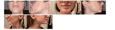 hormonal acne pictures: before and after