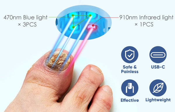 Oveallgo™ ProX Revolutionary High-Efficiency Light Therapy Device For Toenail Diseases