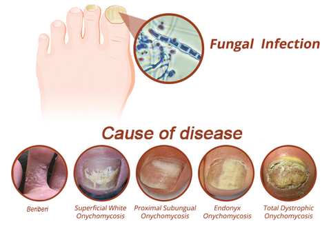 Oveallgo™ NailFungal CleaningLaser TherapeuticDevice
