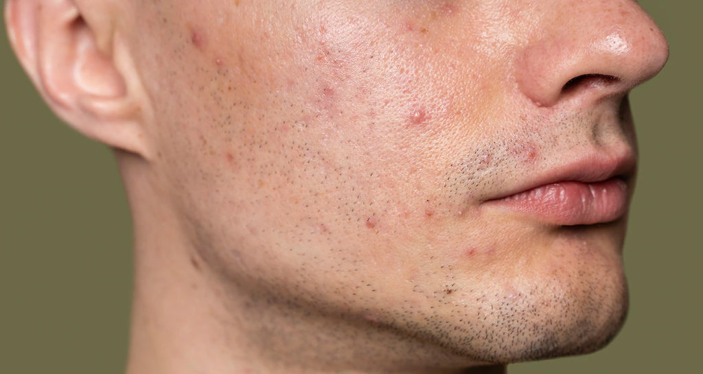 ACNE: WHAT IS IT AND HOW CAN I REDUCE IT?