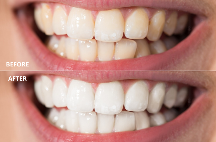 best home use teeth whitening kit - denteeq.com