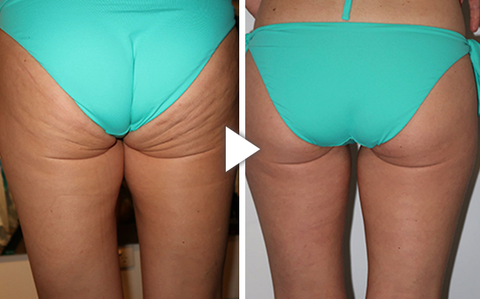 CellaFirm Cellulite Reduction Patches
