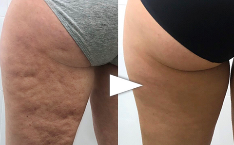 CellaFirm Cellulite Reduction Patches
