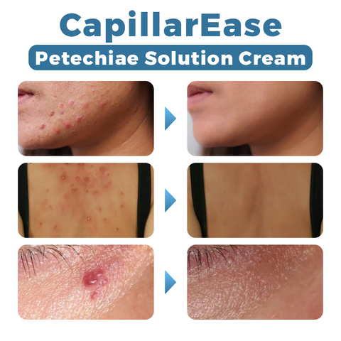 CapillarEase Petechiae Solution Cream