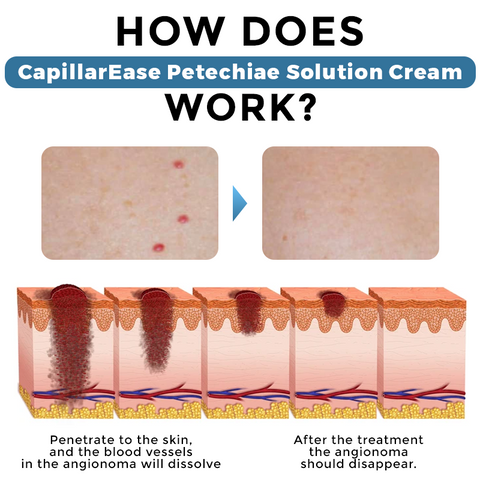 CapillarEase Petechiae Solution Cream