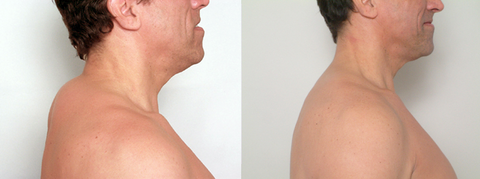 Antes y después del instrumento calmante linfático ultrasónico SLIMORY para el cuello en Rob Williams