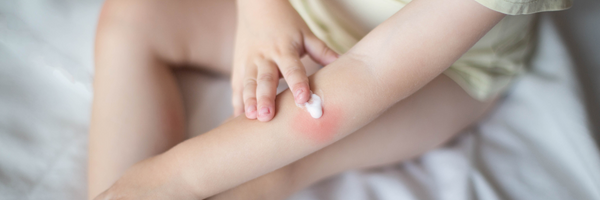 Applicazione di crema per eczemi senza cortisone