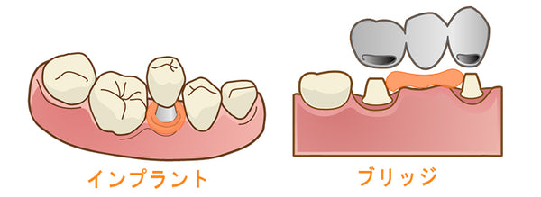 インプラント・ブリッジ