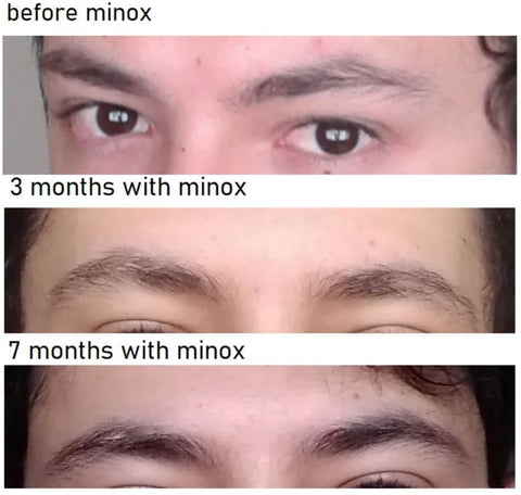 minoxidil before and after eyebrows