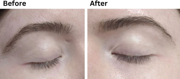 minoxidil before and after eyebrows