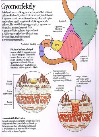 gyomorfekély