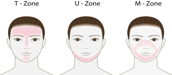 Maskne M-zone - infographic by bareLUXE