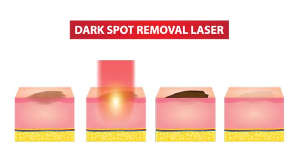 stock image of hyperpigmentation laser removal