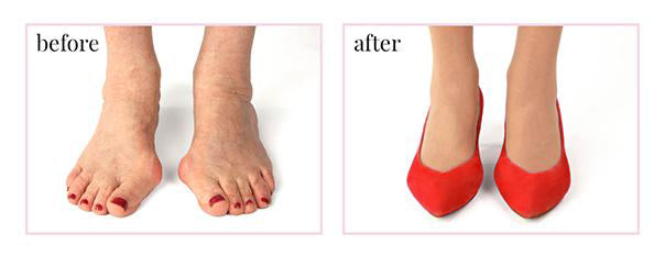 image showing how sole bliss shoes help with bunions