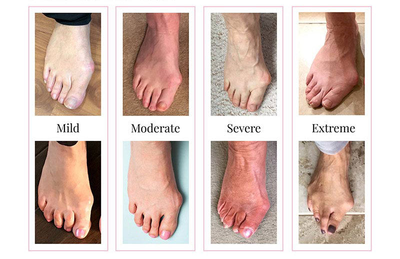 bunion severity chart sole bliss