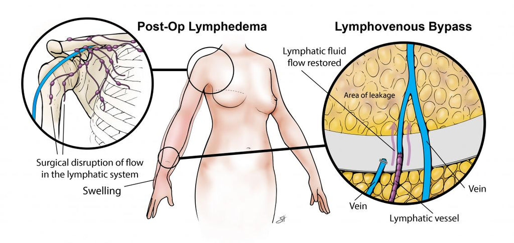 Oveallgo™ Parche Cuidado Linfático para la Salud de la Mujer