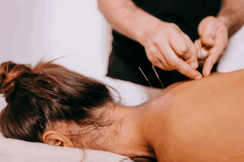 Femme recevant l'acupuncture