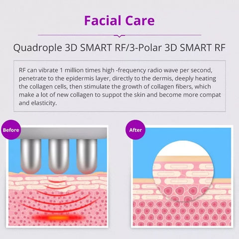 Facial Care Treatment with Quadruple RF of Unoisetion Cavitation Machine