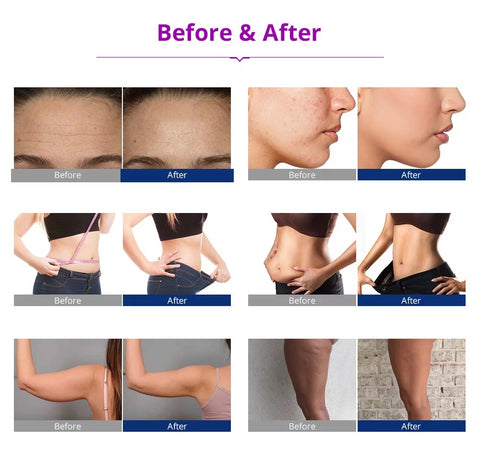 Before and After Using Unoisetion RF Cavitation Machine, Effects on Face, Belly, Arms, and Thighs
