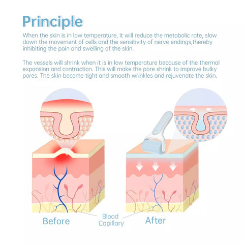 Principle of Using Ice Massage Roller to Reduce Skin Inflation