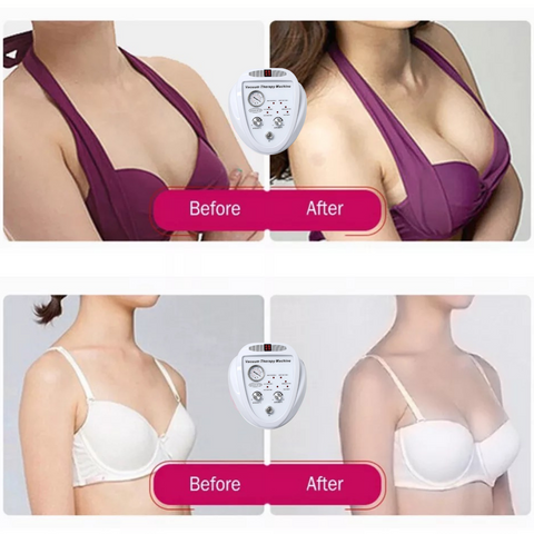 Before and after using Vacuum Therapy Machine on Breasts