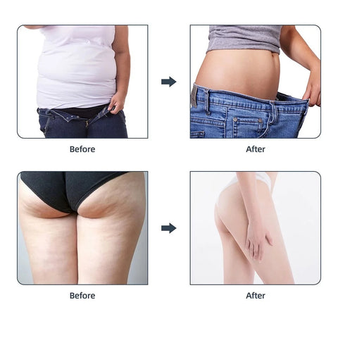 Before and after results of 40k Fat Blasting Lipo Cavitation Machine