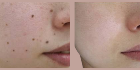 Before and after using rejuva fresh skin tag removal pen