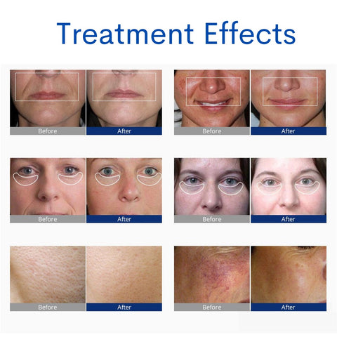 Before and After Treatment Effects of 7 in 1 Professional Skin Analysis Hydrafacial Machine