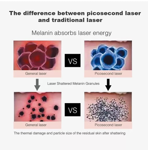 Difference between Picolaser and traditional laser tattoo removal