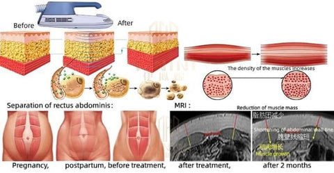 Changes in the fat and muscle layers resulting from EMSlim treatment