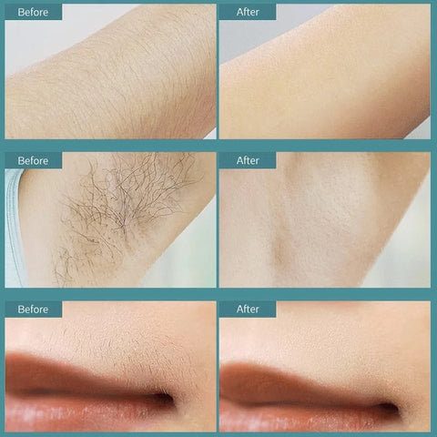 Before and after using IPL Device on arm, underarm, and lip areas