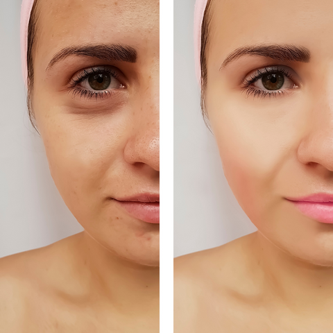 Before and After Hydrafacial Treatment