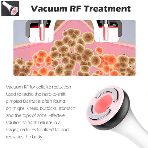 Vacuum RF Treatment, Probe Vacuums up the disrupted fat cells