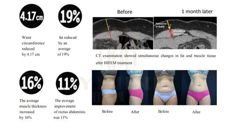 Fat reduction, waist circumference reduction, and muscle increase from EMSculpt Treatment